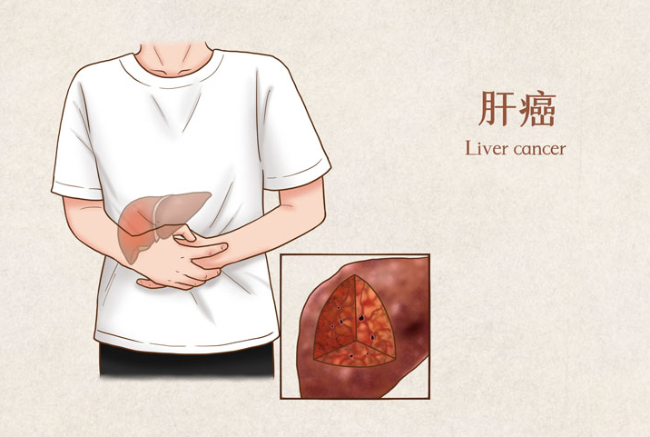 肝癌国外治疗方案：寻找更优治疗路径的新选择