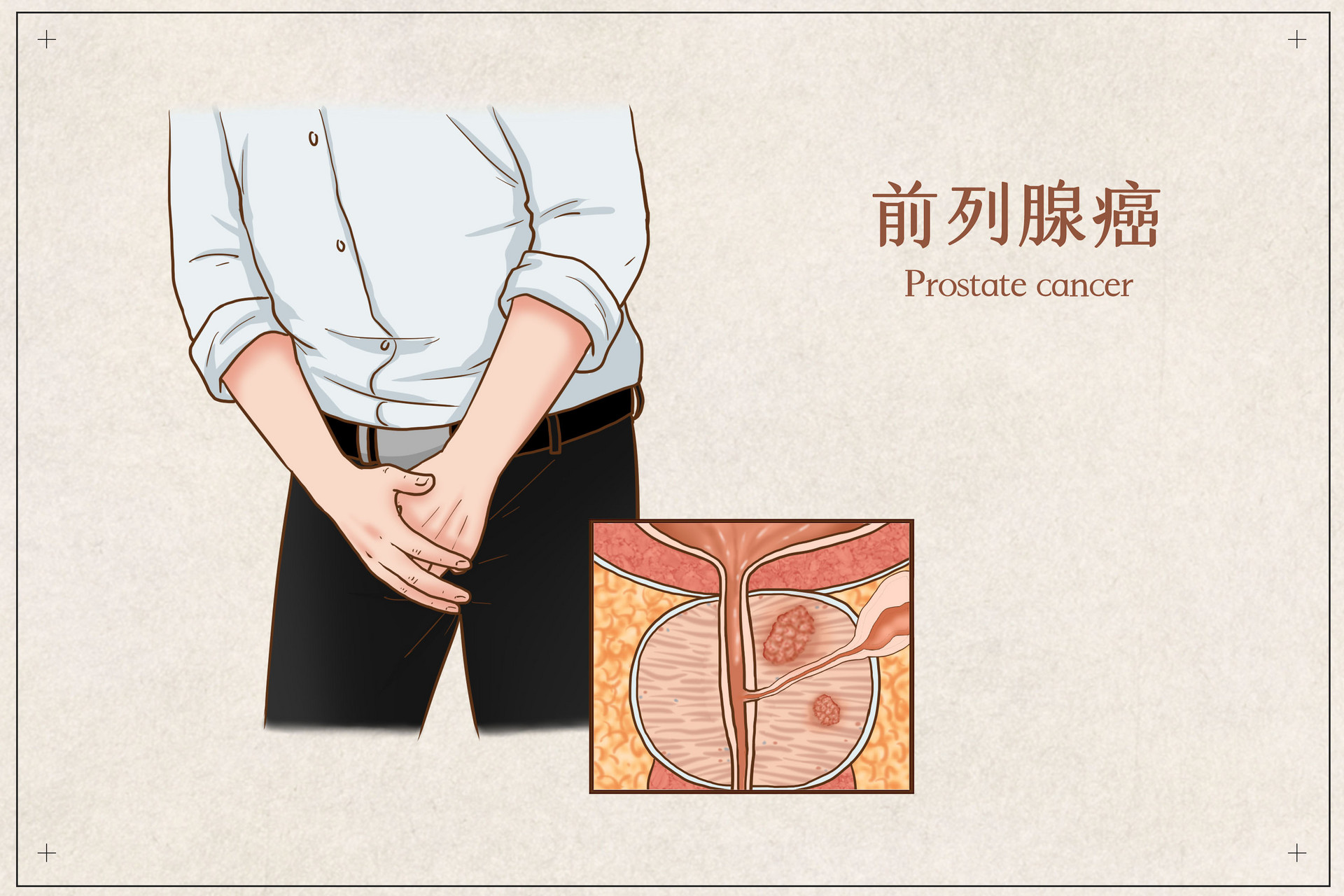 出国治疗前列腺癌