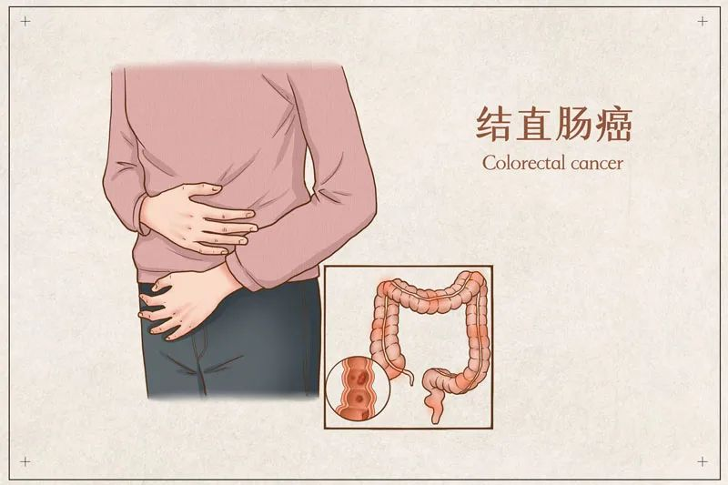 日本结直肠癌手术的优势与治疗生存率 日本结直肠癌手术的优势与治疗生存率