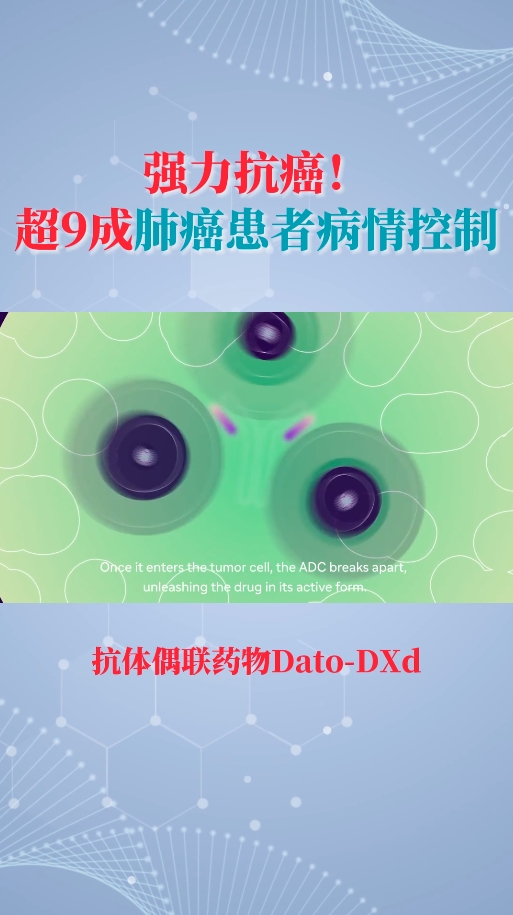 海外医疗前沿：抗体欧联药物Dato-DXd联合免疫治疗 超9成肺癌患者疗效显著