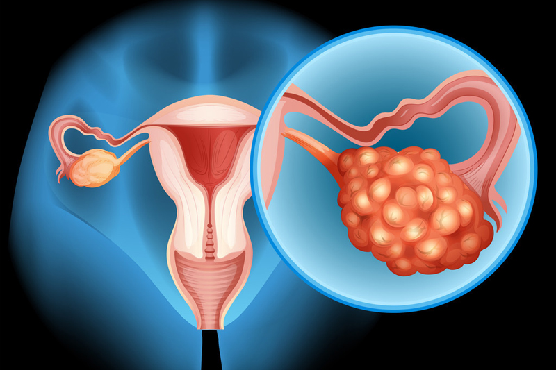 50%患者肿瘤明显缩小或消失!前沿药R-DXd给铂耐药卵巢癌患者带来新希望