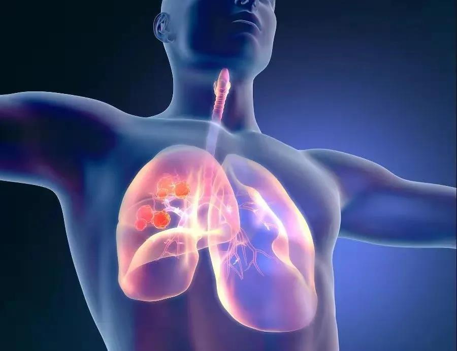 肺癌出国治疗如何参与临床试验？5步实操指南 + 前沿方向解析