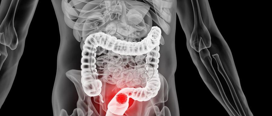 结肠癌出国治疗的预约流程及医院推荐