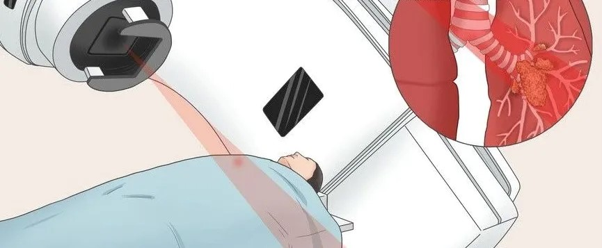 肺癌质子治疗:应该选择哪些医院的质子中心? 肺癌质子治疗:应该选择哪些医院的质子中心?