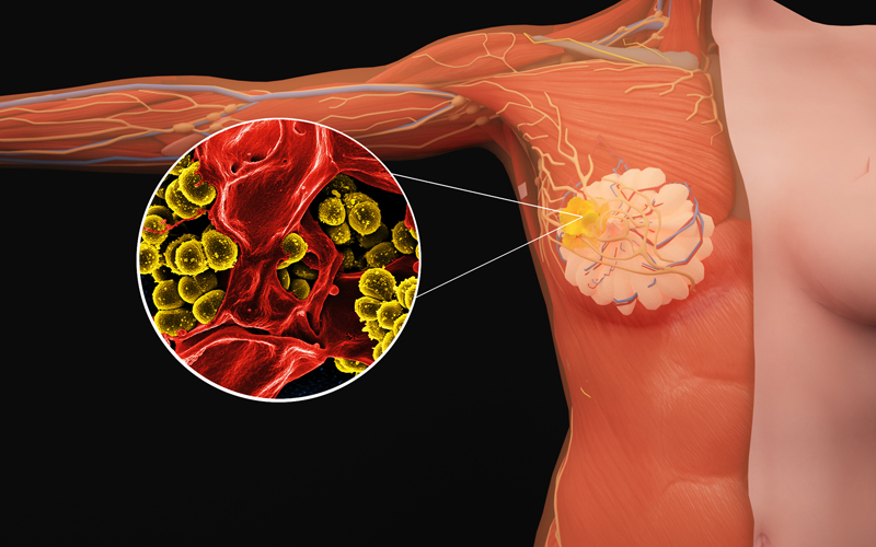 乳腺癌出国治疗优势与前沿药物:精准破局,改写生存预后 乳腺癌出国治疗优势与前沿药物:精准破局,改写生存预后