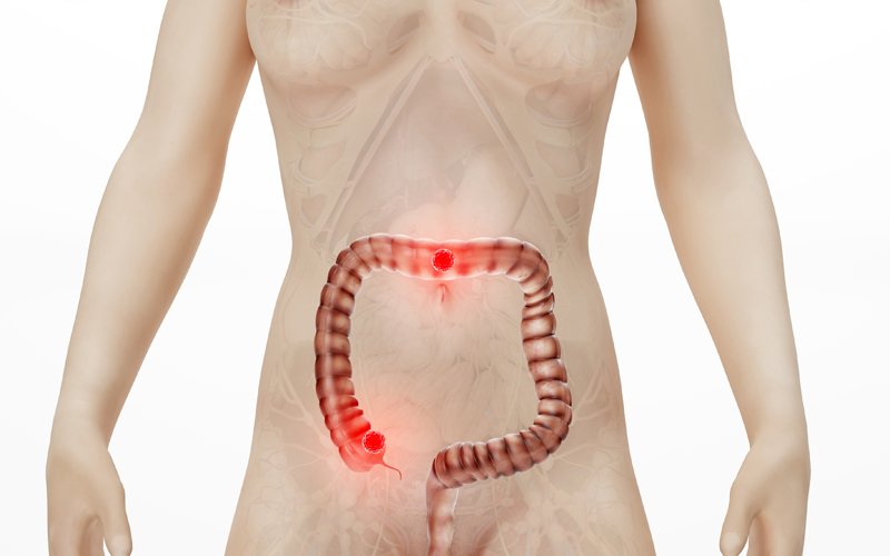 中国肠癌患者如何去美国就医?参与国际临床试验 中国肠癌患者如何去美国就医?参与国际临床试验