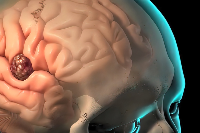 AMXT 1501联合DFMO获孤儿药资格,为神经母细胞瘤患者带来新希望