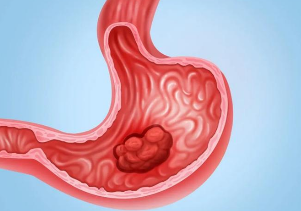 胃癌出国治疗费用及预约流程指南 胃癌出国治疗费用及预约流程指南