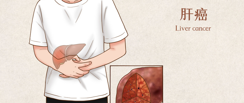 肝癌赴日就医:日本知名医院的官方合作转诊通道 肝癌赴日就医:日本知名医院的官方合作转诊通道