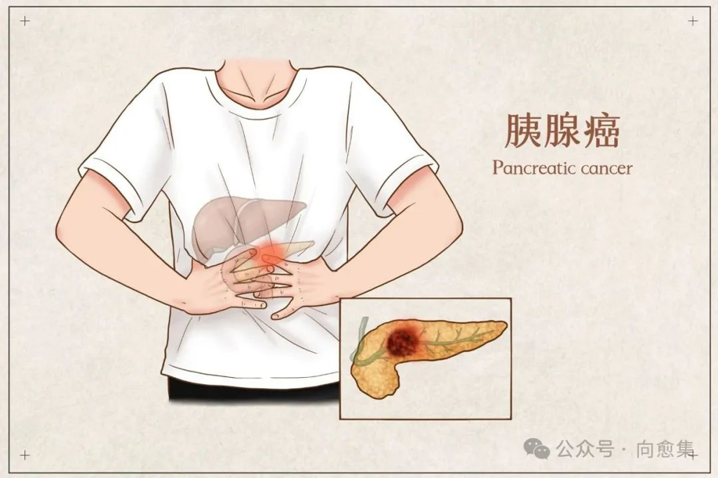 胰腺癌新药