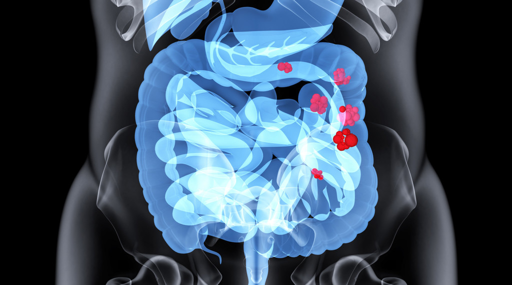 2025年美国胃肠道肿瘤医院排名发布：前沿疗法与就医路径全解读