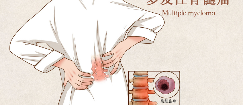 新突破!三药组合疗法让83%多发性骨髓瘤患者肿瘤大幅缩小,其中41%患者肿瘤全消失!