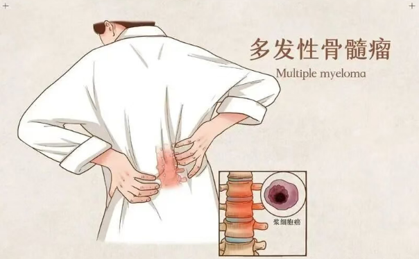 女王“骨癌”传闻登热搜，关于多发性骨髓瘤我们应该知道的事